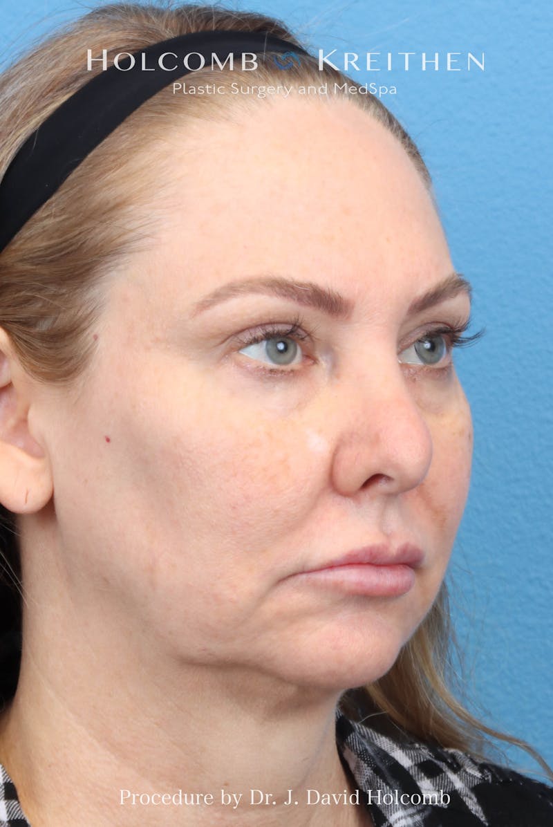 eCO2 Fractional Laser Before & After Gallery - Patient 193988 - Image 3