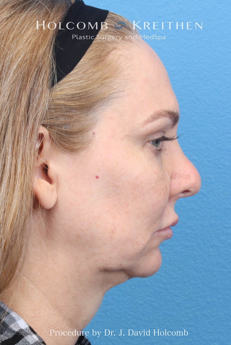eCO2 Fractional Laser Before & After Gallery - Patient 193988 - Image 5