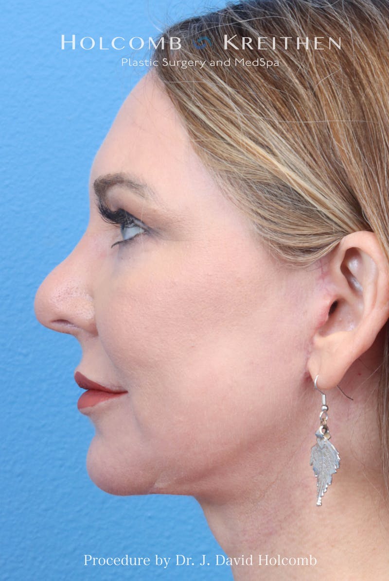 eCO2 Fractional Laser Before & After Gallery - Patient 193988 - Image 8