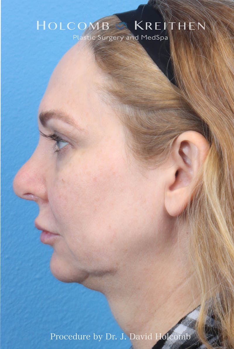 eCO2 Fractional Laser Before & After Gallery - Patient 193988 - Image 7