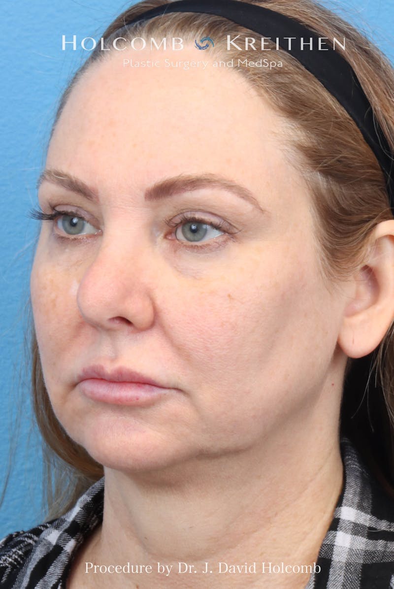 eCO2 Fractional Laser Before & After Gallery - Patient 193988 - Image 9