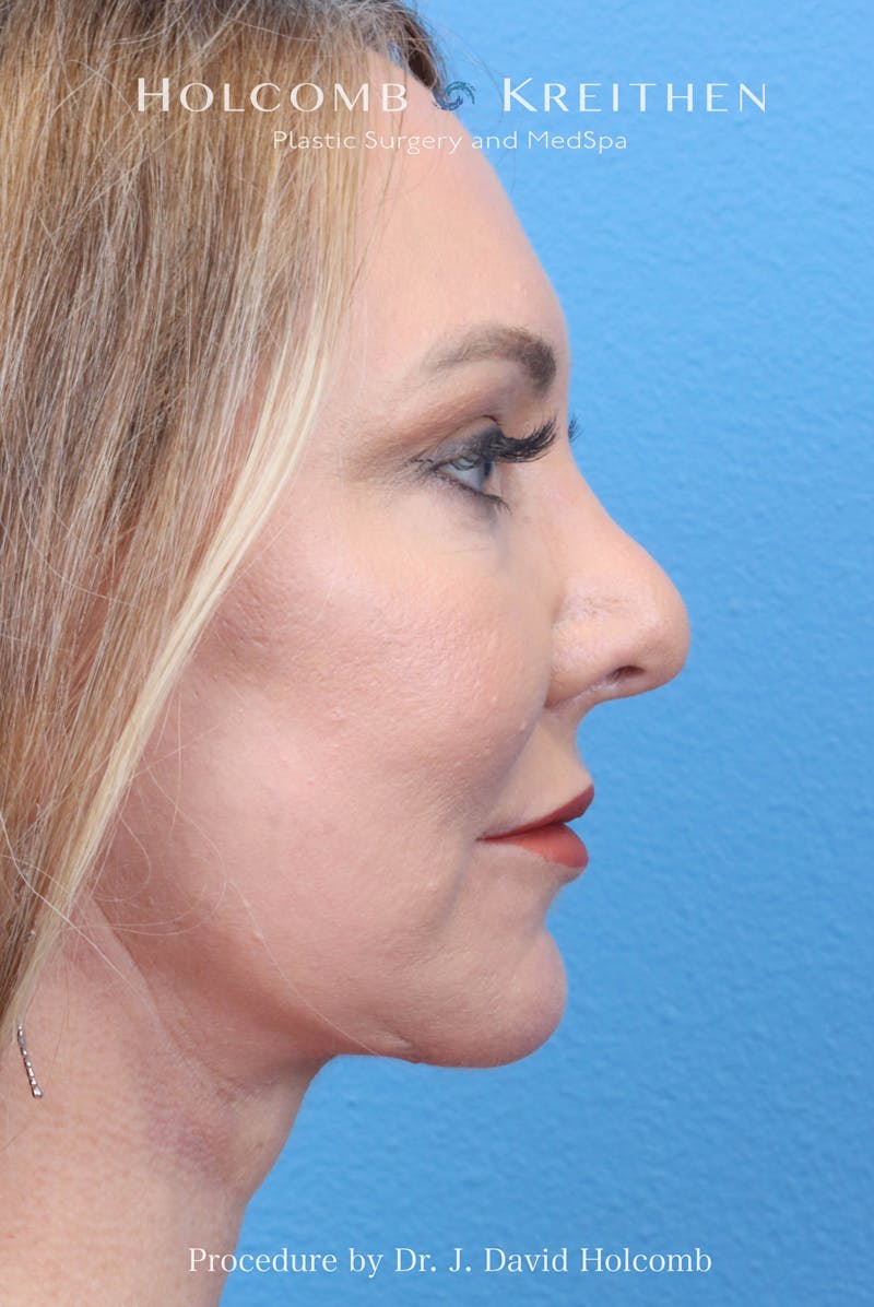 eCO2 Fractional Laser Before & After Gallery - Patient 193988 - Image 6