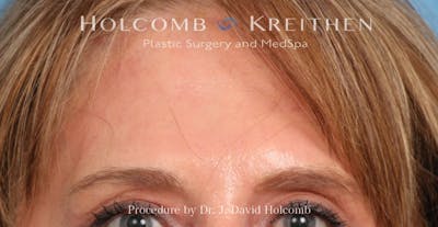 Browlift Before & After Gallery - Patient 422589 - Image 2