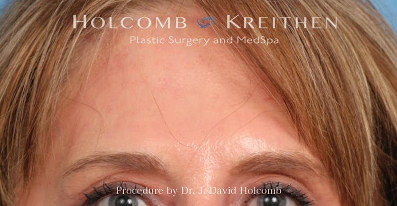 Browlift Before & After Gallery - Patient 422589 - Image 2