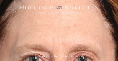 Browlift Before & After Gallery - Patient 422589 - Image 1