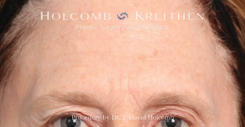 Browlift Before & After Gallery - Patient 422589 - Image 1