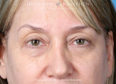 Blepharoplasty Before & After Gallery - Patient 128847 - Image 1