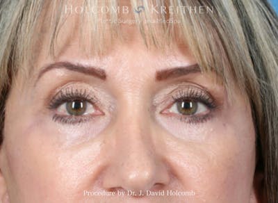 Blepharoplasty Before & After Gallery - Patient 128847 - Image 2