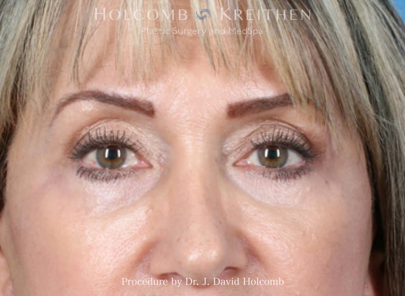 Blepharoplasty Before & After Gallery - Patient 128847 - Image 2