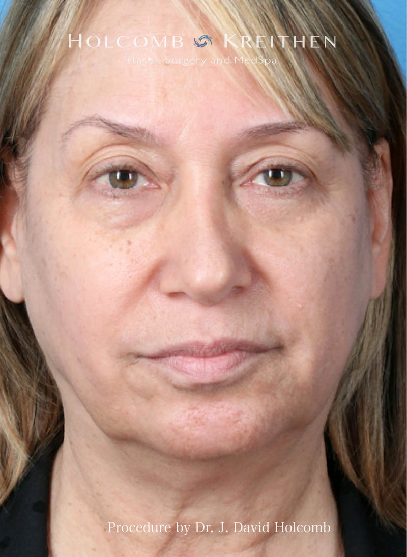 Facelift Before & After Gallery - Patient 779886 - Image 3