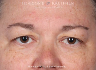 eCO2 Fractional Laser Before & After Gallery - Patient 446962 - Image 1
