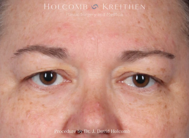 eCO2 Fractional Laser Before & After Gallery - Patient 446962 - Image 1