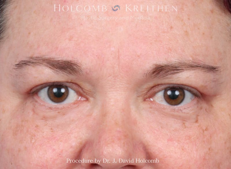 eCO2 Fractional Laser Before & After Gallery - Patient 446962 - Image 2