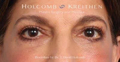Blepharoplasty Before & After Gallery - Patient 319536 - Image 1