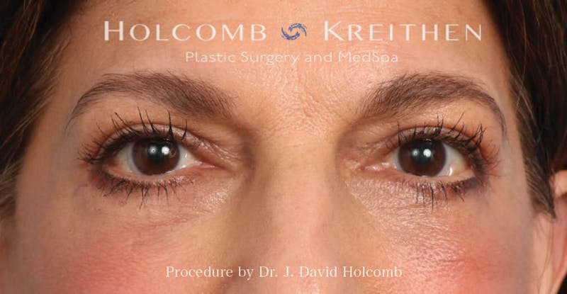 Blepharoplasty Before & After Gallery - Patient 319536 - Image 1