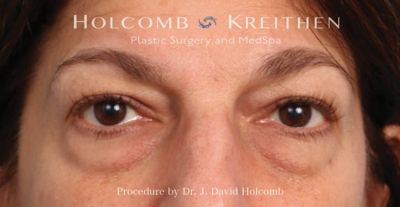 Blepharoplasty Before & After Gallery - Patient 319536 - Image 2