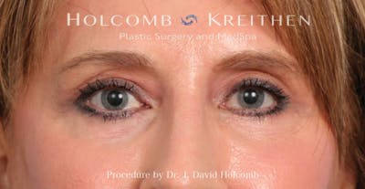 Blepharoplasty Before & After Gallery - Patient 355535 - Image 1