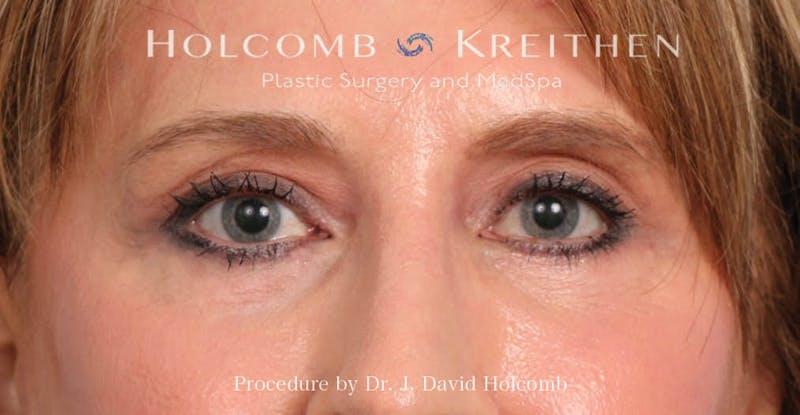 Blepharoplasty Before & After Gallery - Patient 355535 - Image 1
