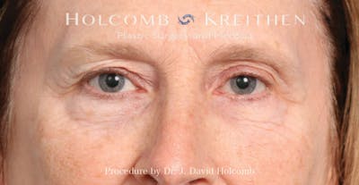 Blepharoplasty Before & After Gallery - Patient 355535 - Image 2