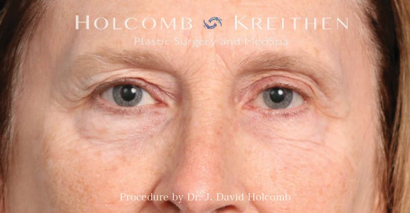Blepharoplasty Before & After Gallery - Patient 355535 - Image 2