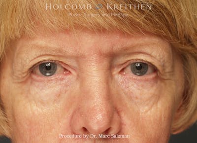 Blepharoplasty Before & After Gallery - Patient 354477 - Image 1
