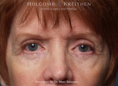 Blepharoplasty Before & After Gallery - Patient 354477 - Image 2