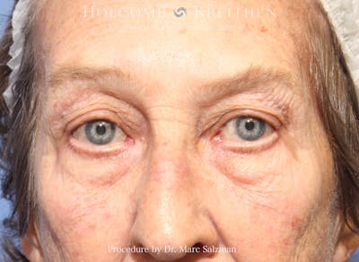 Blepharoplasty Before & After Gallery - Patient 161364 - Image 1