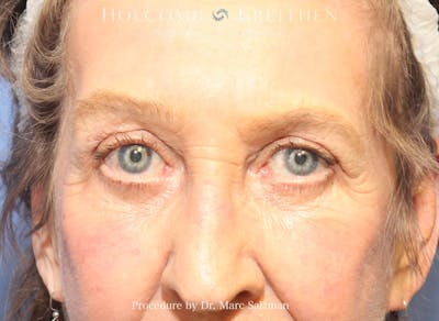 Blepharoplasty Before & After Gallery - Patient 161364 - Image 2