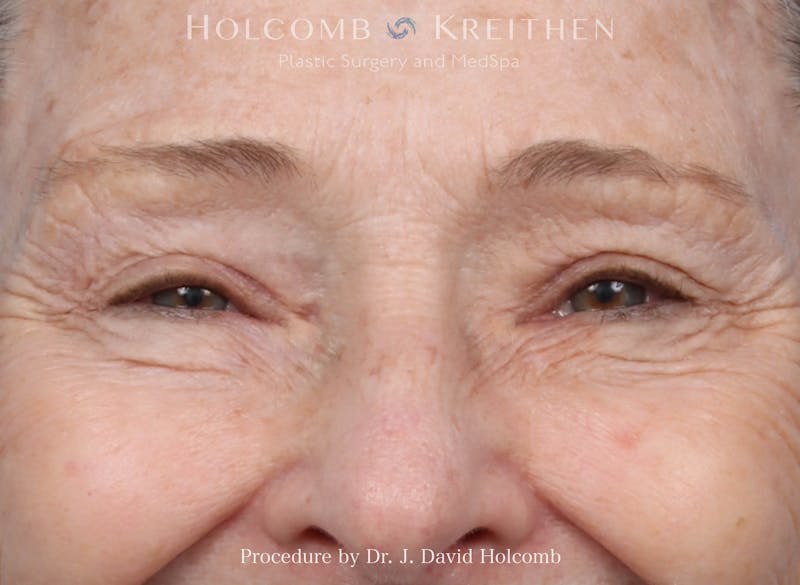 Blepharoplasty Before & After Gallery - Patient 249474 - Image 1