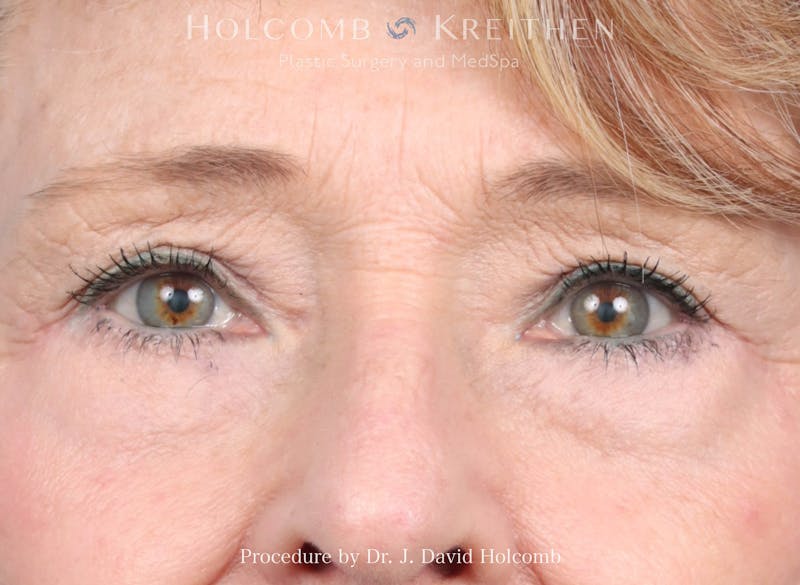 Blepharoplasty Before & After Gallery - Patient 249474 - Image 2