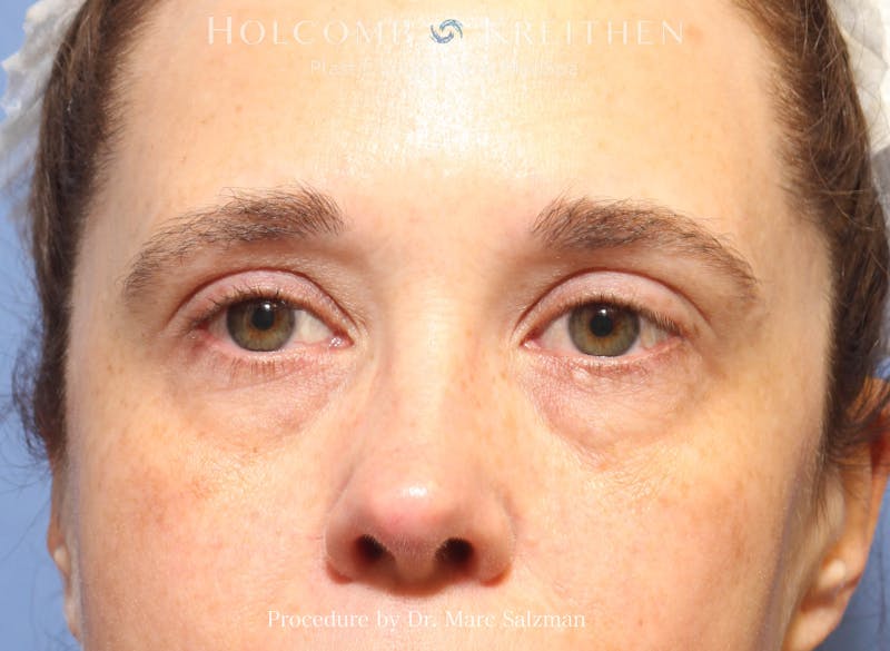 Blepharoplasty Before & After Gallery - Patient 298619 - Image 1