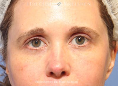 Blepharoplasty Before & After Gallery - Patient 298619 - Image 2