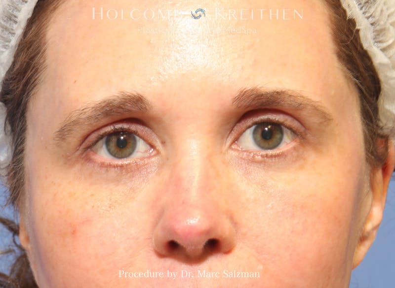 Blepharoplasty Before & After Gallery - Patient 298619 - Image 2