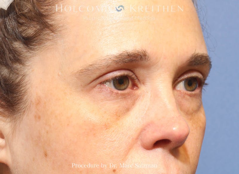Blepharoplasty Before & After Gallery - Patient 298619 - Image 3
