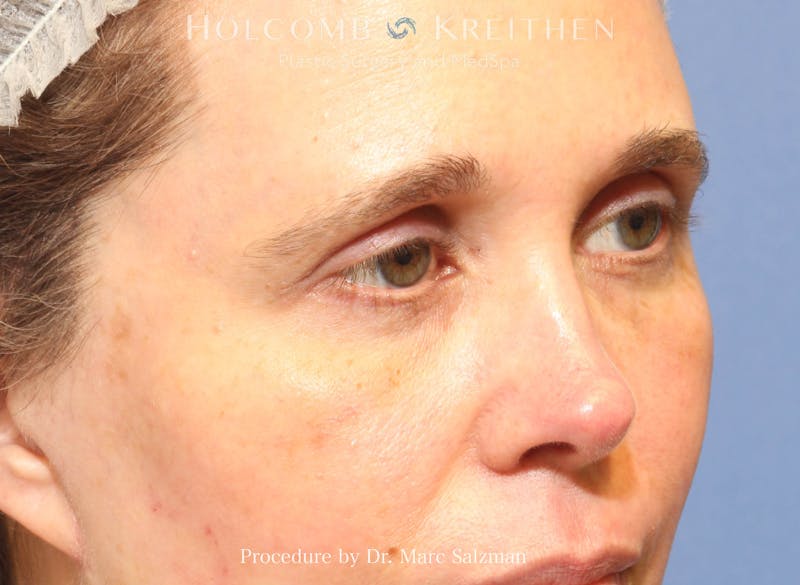 Blepharoplasty Before & After Gallery - Patient 298619 - Image 4