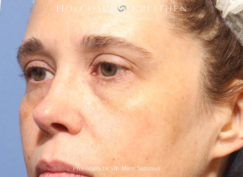 Blepharoplasty Before & After Gallery - Patient 298619 - Image 5
