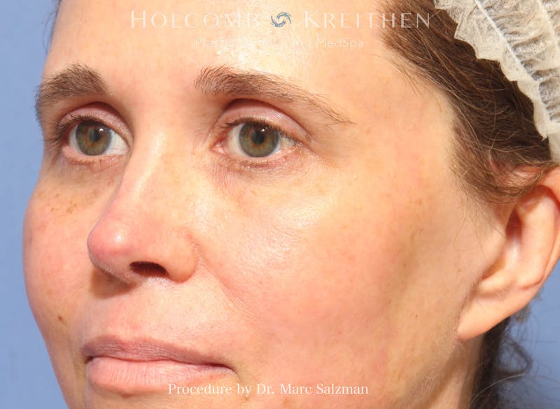 Blepharoplasty Before & After Gallery - Patient 298619 - Image 6