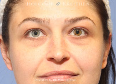 Blepharoplasty Before & After Gallery - Patient 296728 - Image 1