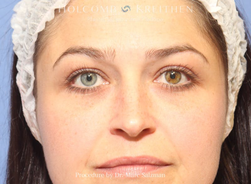 Blepharoplasty Before & After Gallery - Patient 296728 - Image 2