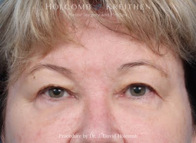 Blepharoplasty Before & After Gallery - Patient 253938 - Image 1