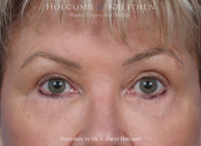 Blepharoplasty Before & After Gallery - Patient 253938 - Image 2