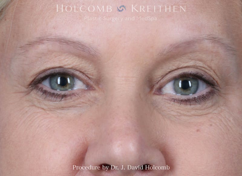 Blepharoplasty Before & After Gallery - Patient 268281 - Image 1