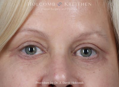 Blepharoplasty Before & After Gallery - Patient 268281 - Image 2