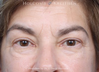 Blepharoplasty Before & After Gallery - Patient 197904 - Image 1