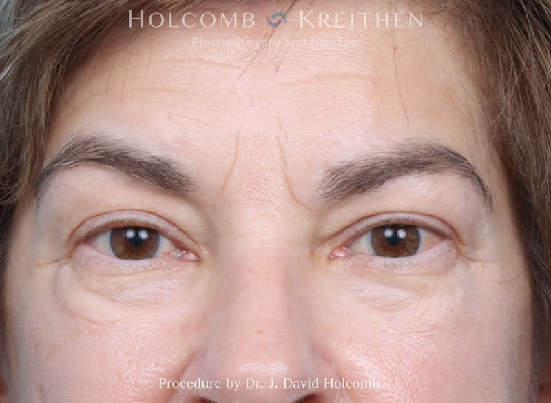 Blepharoplasty Before & After Gallery - Patient 197904 - Image 1