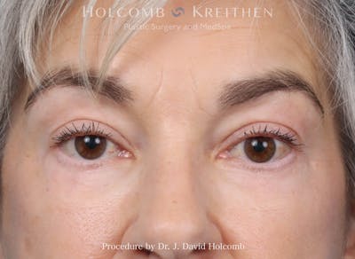 Blepharoplasty Before & After Gallery - Patient 197904 - Image 2