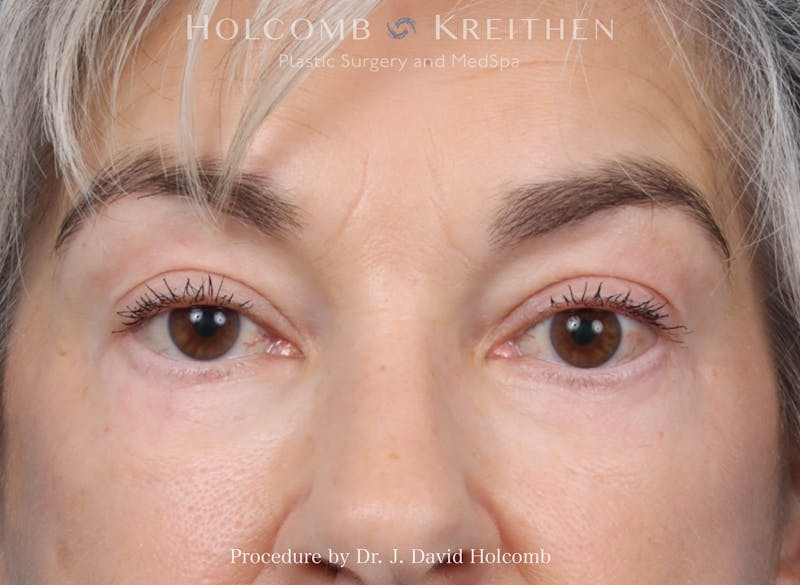Blepharoplasty Before & After Gallery - Patient 197904 - Image 2