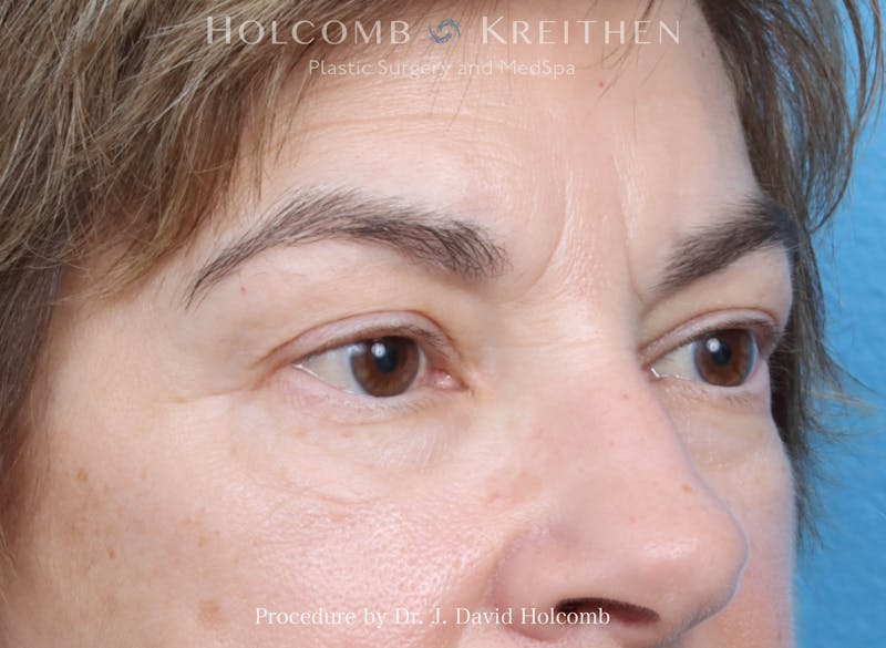 Blepharoplasty Before & After Gallery - Patient 197904 - Image 3