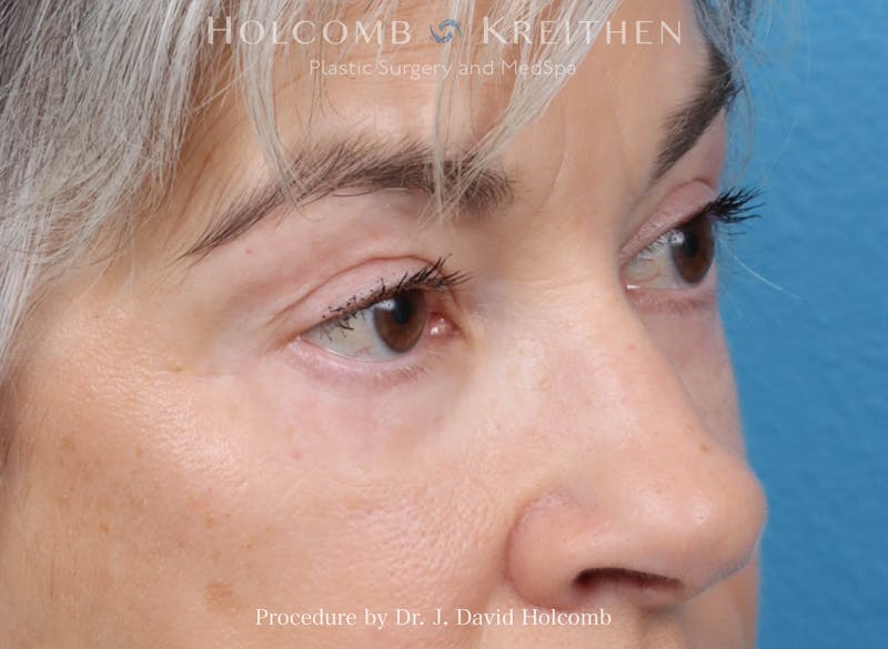 Blepharoplasty Before & After Gallery - Patient 197904 - Image 4