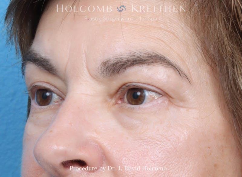 Blepharoplasty Before & After Gallery - Patient 197904 - Image 5